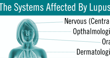 Systems Affected by Lupus
